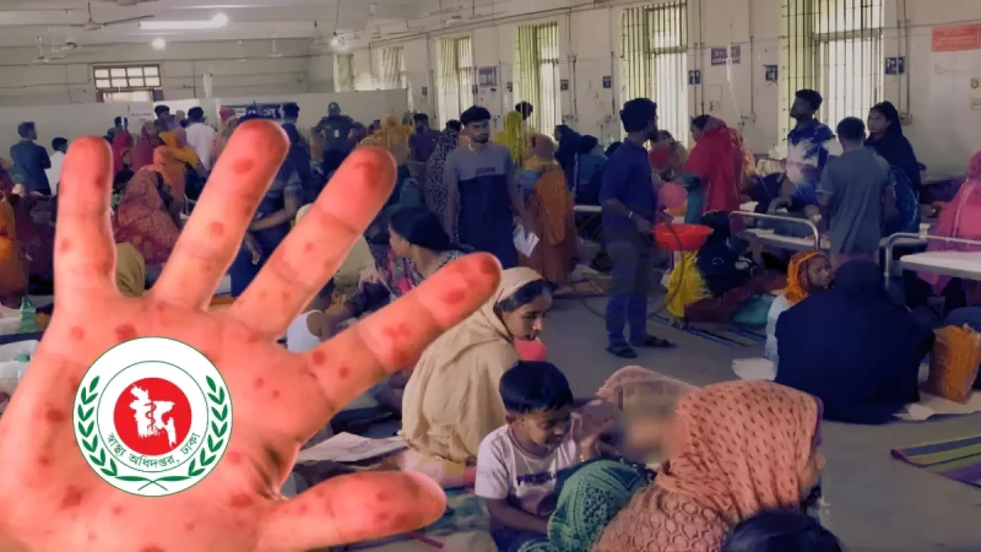 হাম ও হামের উপসর্গ নিয়ে দেশে আরও ১১ শিশুর মৃত্যু